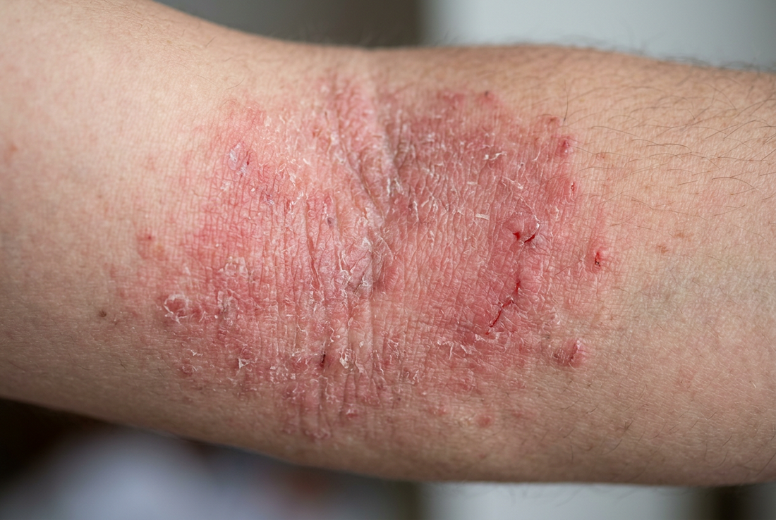 The Truth About Eczema: Triggers, Solutions, and My Personal Healing Journey